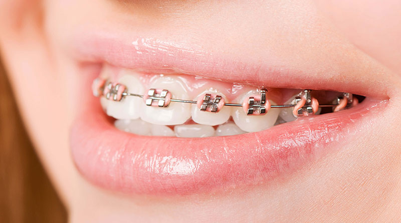 Niềng răng 1 hàm trên giá bao nhiêu? 6 Chi Phí Niềng Răng 1 Hàm Giá Bao Nhiêu? Có Niềng Được Không?