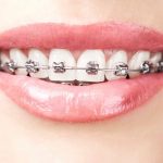 Tác hại của niềng răng sẽ rất rõ rệt nếu bạn đang gặp các vấn đề về răng miệng
