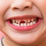 Sún răng cửa ở trẻ và những điều cha mẹ cần biết