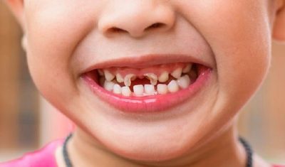 Sún răng cửa ở trẻ và những điều cha mẹ cần biết
