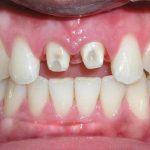 Bọc răng sứ bị hở có thể trở thành mối rủi ro đáng lo ngại