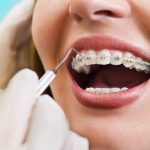 [Giải đáp chi triết] Có nên niềng răng nhổ răng số 3 hay không?