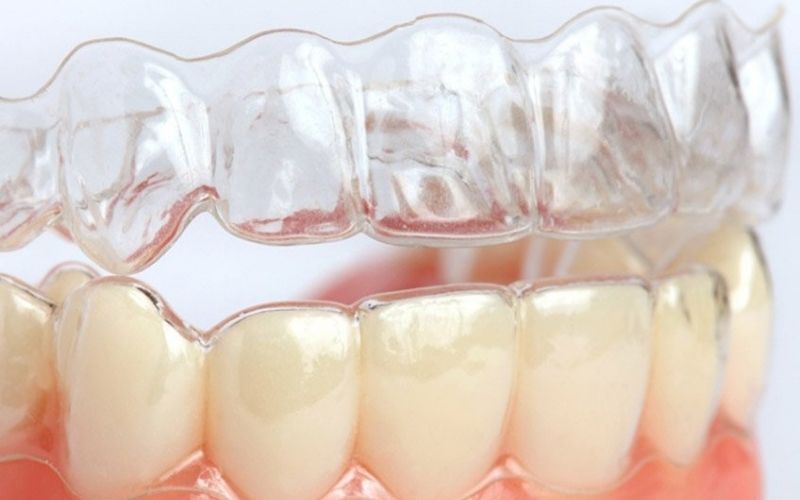 Niềng răng Invisalign bao lâu thì hoàn tất?