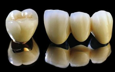 Bọc răng sứ kim loại thường có tốt không, địa chỉ bọc răng uy tín