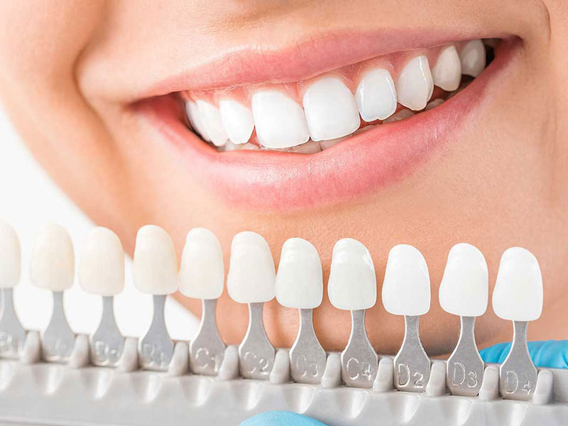 Trước Và Sau Khi Bọc Răng Sứ Cần Lưu Ý Những Gì?
