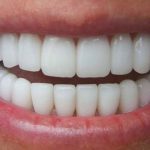 Trồng răng sứ nguyên hàm - 6 điều cần biết trước khi thực hiện