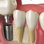 [Giải đáp] Bảng giá trồng răng Implant bệnh viện Răng Hàm Mặt