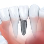14 Địa Chỉ Trồng Răng Implant Đà Nẵng Tốt Nhất Hiện Nay