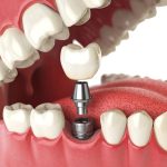 Có Nên Trồng Răng Implant Miễn Phí Giá Rẻ Không, Cần Lưu Ý Gì?