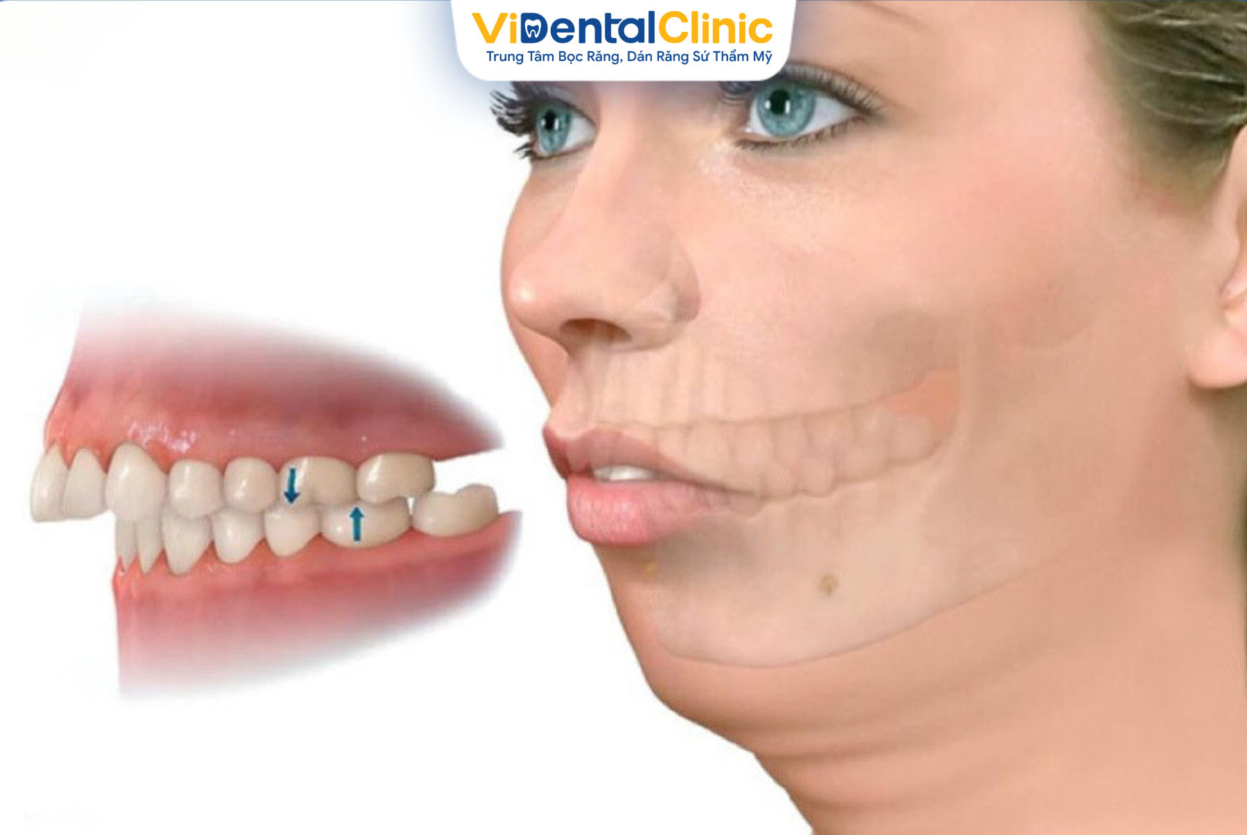Bọc sứ là kỹ thuật chỉnh hình cho răng hô được áp dụng phổ biến trong nha khoa