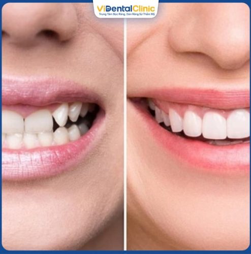Có 2 màu răng sứ phổ biến để khách hàng lựa chọn