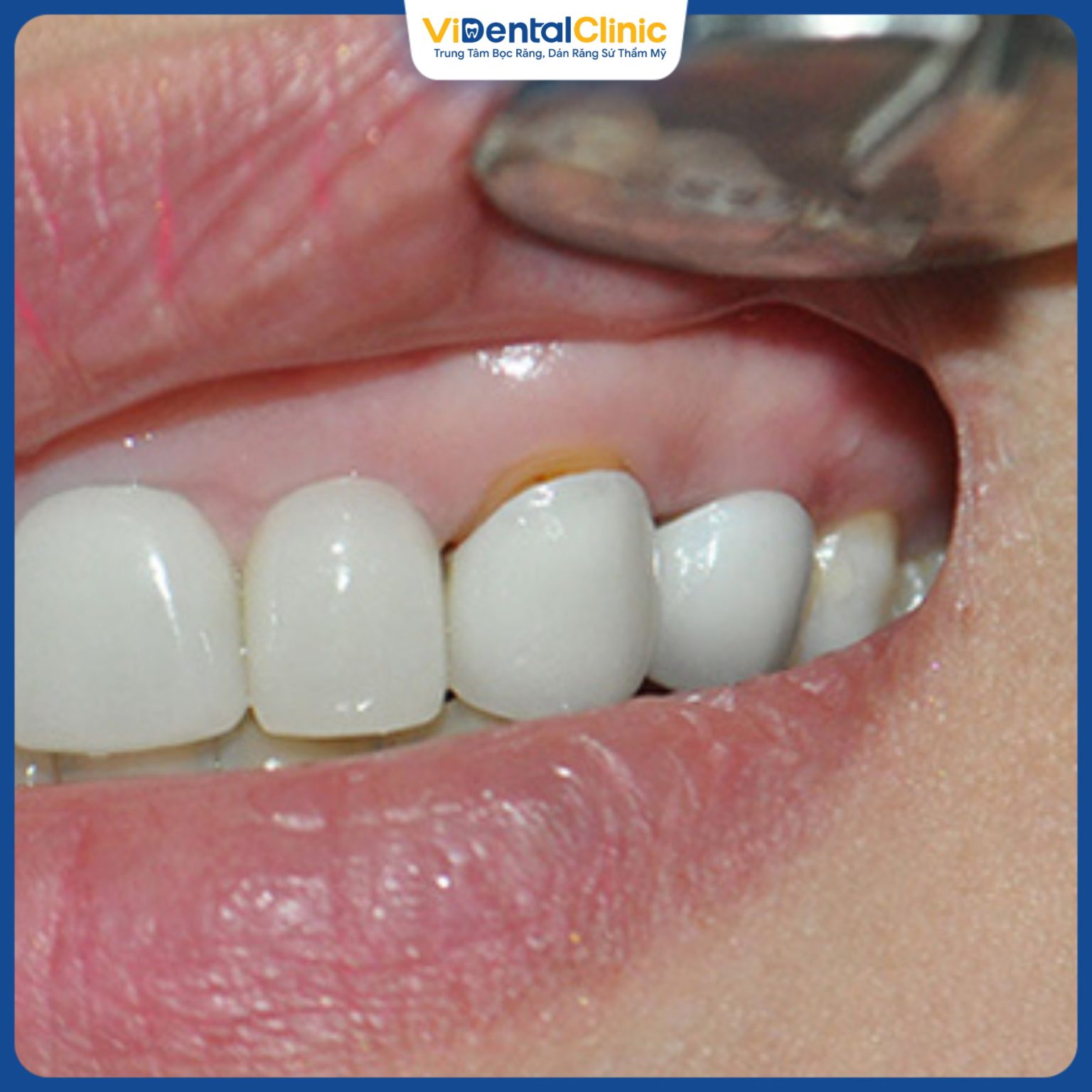 Bọc Răng Sứ Implant: Giải Pháp Hoàn Hảo Cho Hàm Răng Khỏe Đẹp