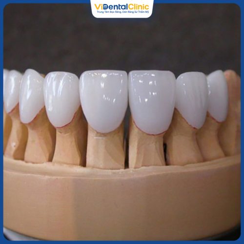 Chọn răng toàn sứ để bọc sứ 16 răng có nhiều ưu điểm