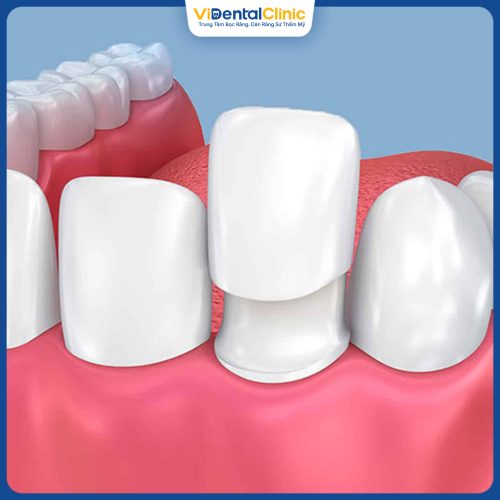 Gắn răng tạm sau khi mài răng giúp bảo vệ cùi răng thật