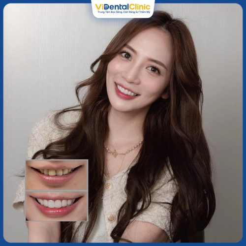 Khách hàng bọc sứ với Beauty smile