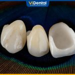 Mẫu Răng Sứ Đẹp Và Cách Lựa Chọn Răng Sứ Phù Hợp Nhất