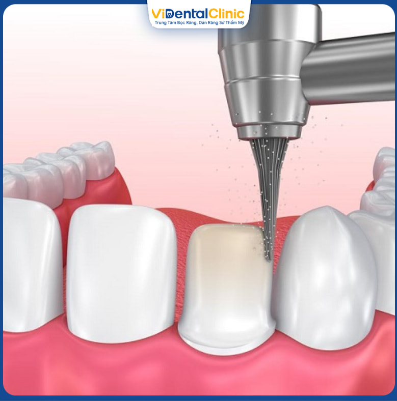 Bọc răng sứ không cần mài răng chỉ được áp dụng trong một vài trường hợp nhất định