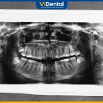 Chụp X-quang Răng: Tác Dụng, Quy Trình Và Lưu Ý Quan Trọng