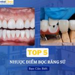 Nhược Điểm Của Bọc Răng Sứ: Top 5 Nguy Cơ Có Thể Bạn Chưa Biết