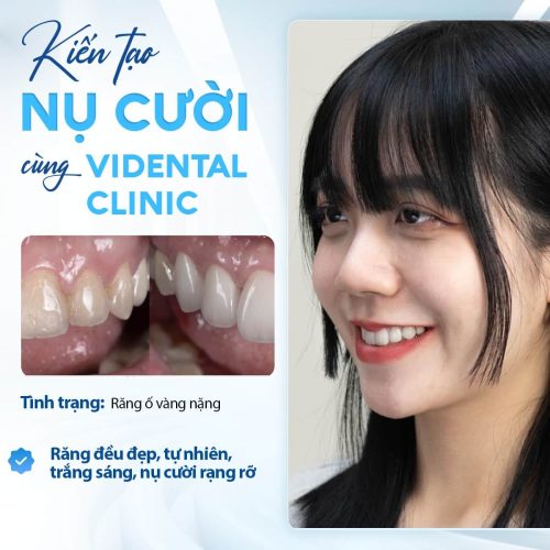 Chị Nguyễn Thùy Chi tự tin với hàm răng sau bọc sứ