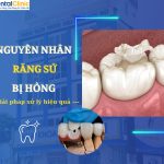 Nguyên Nhân Răng Sứ Bị Hỏng Và Giải Pháp Xử Lý Hiệu Quả