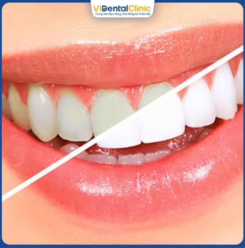 Nhiều người quan tâm việc so sánh răng sứ Zirconia và Cercon
