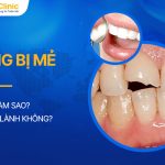 Răng Bị Mẻ Phải Làm Sao? Có Tự Lành Không?