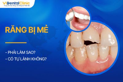 Răng Bị Mẻ Phải Làm Sao? Có Tự Lành Không?