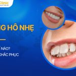 Răng Hô Nhẹ Là Thế Nào? 3 Cách Khắc Phục Hiệu Quả Nhất