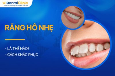 Răng Hô Nhẹ Là Thế Nào? 3 Cách Khắc Phục Hiệu Quả Nhất