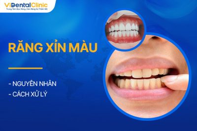 Răng Xỉn Màu Do Đâu? Cách Xử Lý Tại Nhà Và Tại Nha Khoa