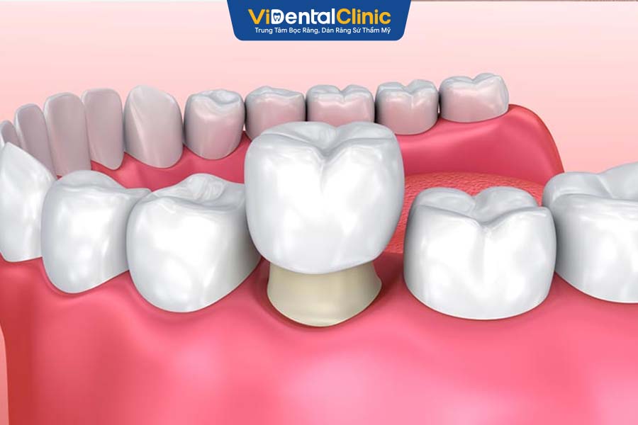 Trồng răng sứ với công nghệ hiện đại tại ViDental