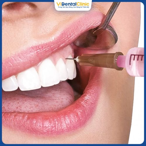 Quá trình lấy tủy bọc răng sứ được tiêm thuốc tê nên hạn chế đau nhức