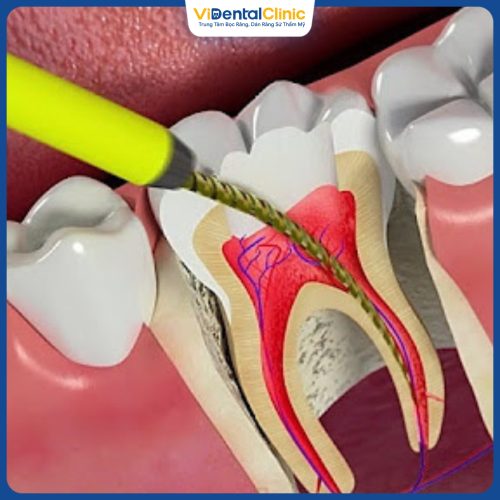 Lấy tuỷ bọc sứ răng khi răng sâu nghiêm trọng, đau nhức, viêm nhiễm nặng