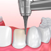 Mài cùi răng làm trụ hoặc cấy trụ Implant vào xương hàm, gắn răng tạm