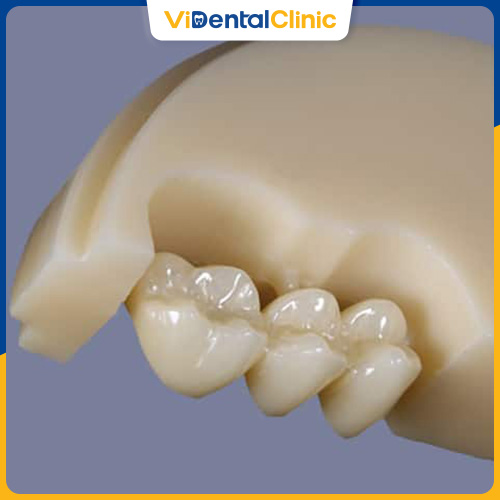 Răng Katana tại ViDental Clinic có giá 4.500.000 VNĐ/răng