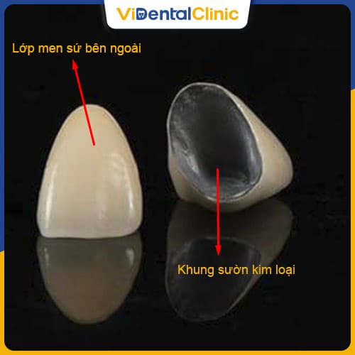 Cấu tạo răng sứ kim loại thường