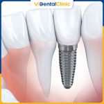 Thời gian cấy ghép Implant khá lâu