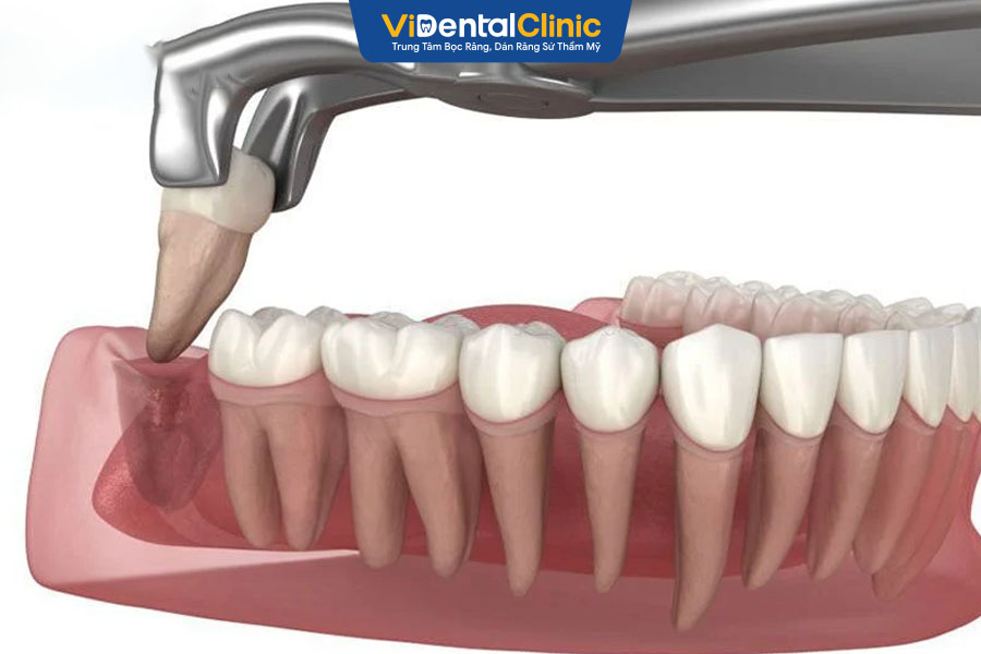 Trám Răng Inlay Onlay Là Gì? Ưu Nhược Điểm, Quy Trình, Chi Phí