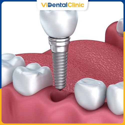Trồng răng giả cố định Implant là phương pháp chỉnh nha hiện đại