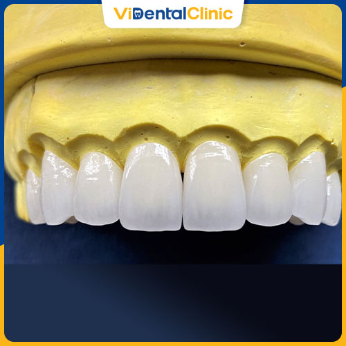 Răng sứ Lava là loại răng sứ Resin Nano Ceramic được sản xuất bởi tập đoàn 3M ESPE tại Mỹ