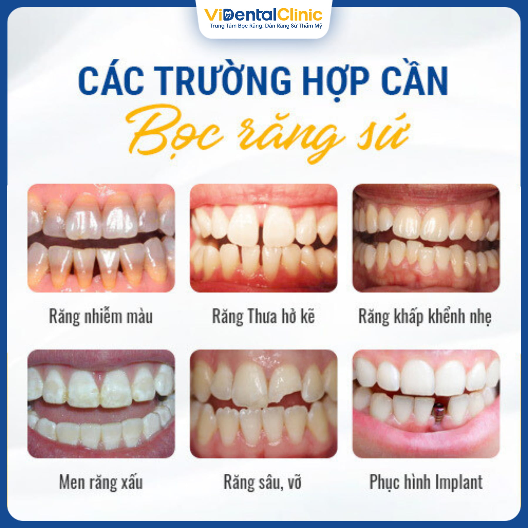 Quy trình bọc răng sứ implant