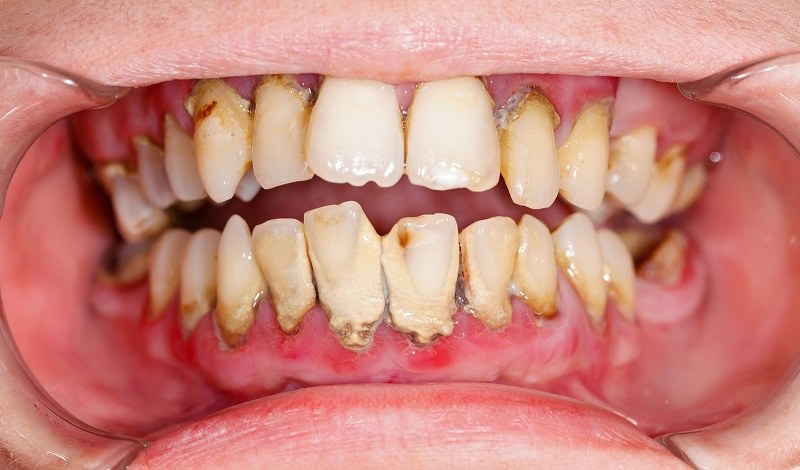 Lấy cao răng là kỹ thuật giúp loại bỏ mảng bám cần được thực hiện định kỳ