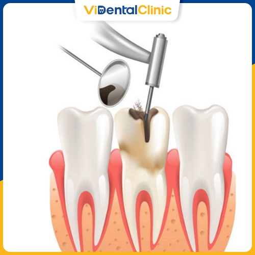 Lấy tuỷ bọc sứ răng khi răng sâu nghiêm trọng, đau nhức, viêm nhiễm nặng