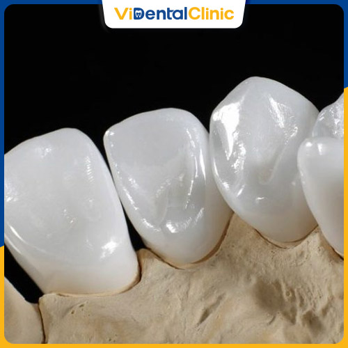 Răng sứ toàn sứ chất lượng hơn răng sứ kim loại
