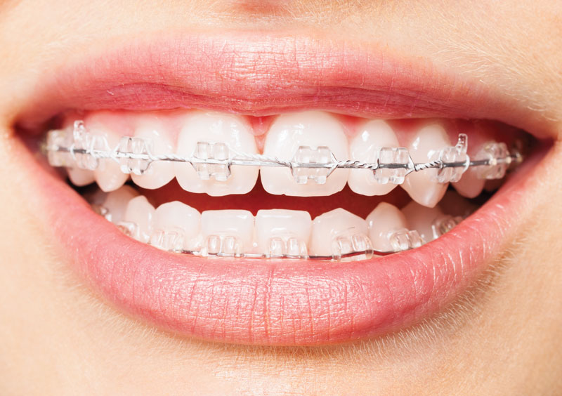 Niềng răng sứ dùng được cho mọi đối tượng khác nhau