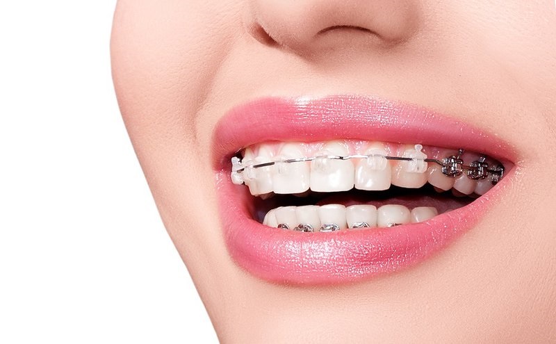 Bạn nên lựa chọn những nha khoa chuyên sâu về niềng răng
