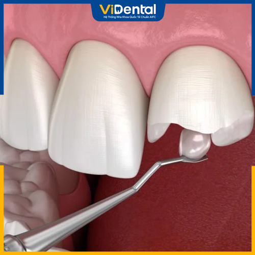 Quy trình trám răng cần được thực hiện đúng chuẩn Y khoa