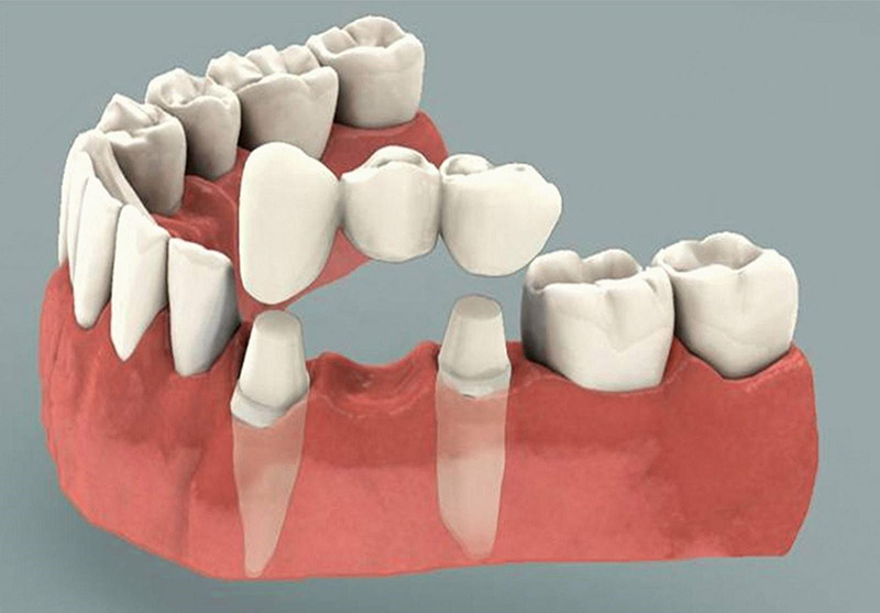Cầu răng sứ là phương pháp trồng răng giả nhanh chóng, ít đau đớn