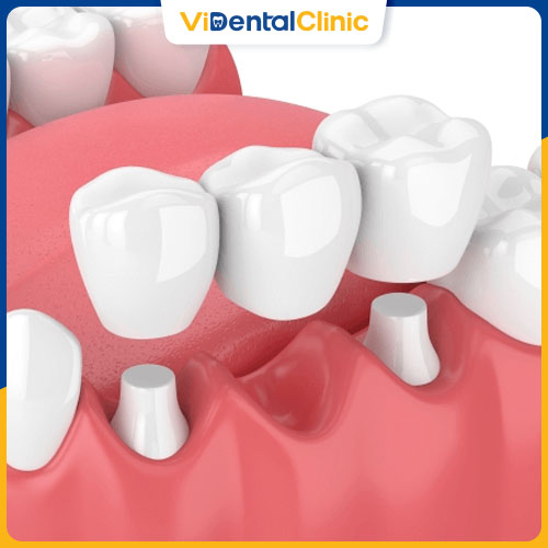 Cầu răng sứ giúp bệnh nhân khôi phục chức năng nhai